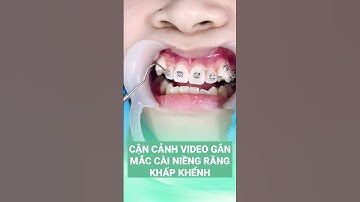 Cận Cảnh Gắn Mắc Cài Niềng Răng Khấp Khểnh | Bác sĩ Thoa Bình Dương