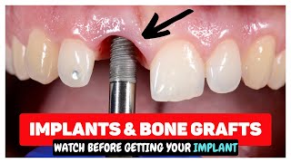 Dental Implants & Bone Grafting after Tooth Extractions by Smile Influencers 103,398 views 2 years ago 3 minutes, 7 seconds
