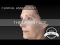 67 yo Female Brow Lift & Facelift | Aesthetic Minutes #BrowLift