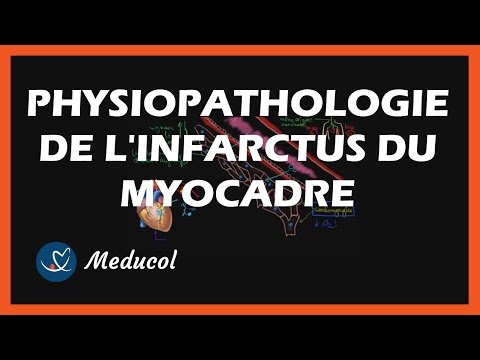 Vidéo: Infarctus Du Myocarde: Symptômes, Qu'est-ce Que C'est, Conséquences, Traitement