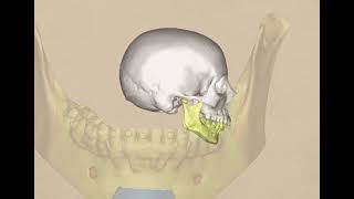 The 4 piece mandible by Dr Paul Coceancig 919 views 1 year ago 2 minutes, 44 seconds