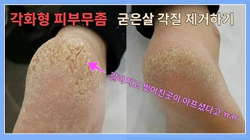 각화형 피부무좀으로 뒤꿈치가 심하게 갈라진 분의 굳은살 각질제거하기 영상입니다.