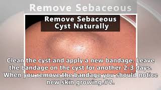 Best Home Remedies for Sebaceous Cysts?