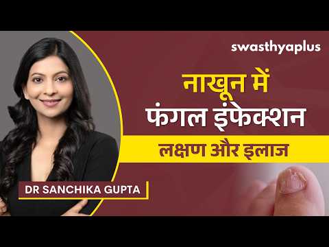 नाखून में फंगल इंफेक्शन: लक्षण और इलाज | Nail Fungus: How to Treat? in Hindi | Dr Sanchika Gupta