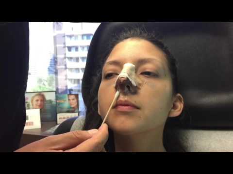 Cara Membersihkan Hidung Setelah Rhinoplasti