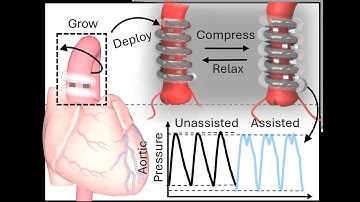 Self‐Deploying Extra‐Aortic Compression Device for Heart Failure Video 1