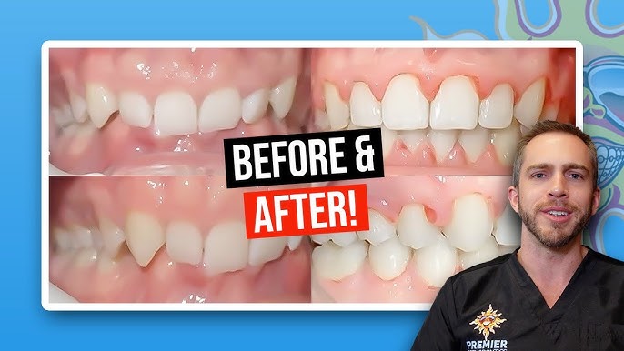 How Do You Fix an Overbite? - Burke & Beckstrom Orthodontics