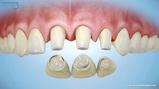 Are Porcelain Veneers Right for You? by Dentalism 458,375 views 10 years ago 1 minute, 35 seconds