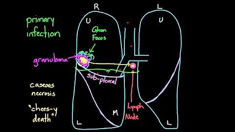 01   Tuberculosis   04   Primary and Secondary TB