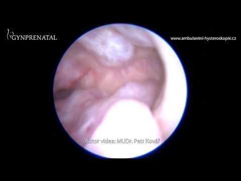 Ovula Nabothi + mnohotné polypy endometria