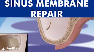 Sinus membrane perforation repair ©