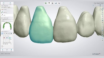 3Shape Clear Aligner Studio workflow with Bernhard Egger