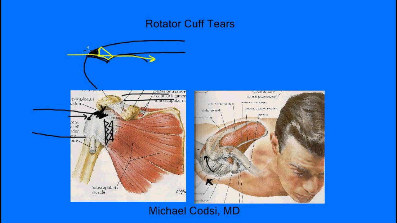 Rotator cuff tear etiology evergreen YouTube