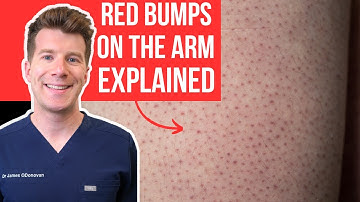 Doctor explains KERATOSIS PILARIS (aka chicken skin) | Causes, treatments and AT HOME MANAGEMENT