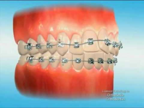 Orthosmile - First Days in Braces