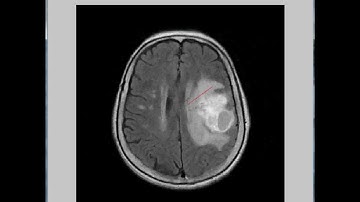 Brain tumor isolation using the Active Contours Model