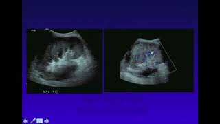 Ultrasound evaluation of  Renal, Liver and Pancreas Transplants