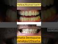 Got yellow teeth? Getting a white smile is easy! #bleaching #teethwhitening