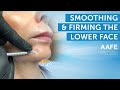 Smoothing Lower Face Fine Lines with Dermal Filler | AAFE