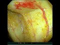 Cecal Angioectasis with Bleed managed with APC