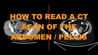 How to read a CT abdomen pelvis scan - introduction to abdominal imaging for junior doctors