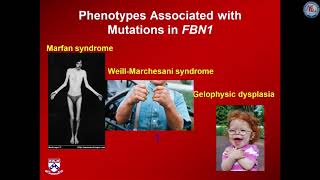 Evolution of the diagnosis, cause and pathogenesis of Marfan syndrome