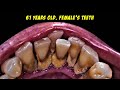 Scaling Routine | Tartar | Dentist | Dokter Gigi Tri Putra