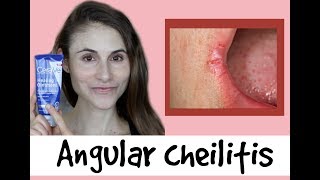 Angular cheilitis causes & treatments: a Q&A with dermatologist Dr Dray