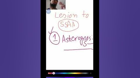 Parietal lobe # (Somatosensory Association Cortex)# Clinically lesions 🧠💥