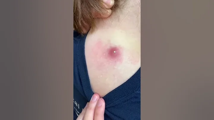 Wasnt expecting that #pimple #pimplepopper202...  ...