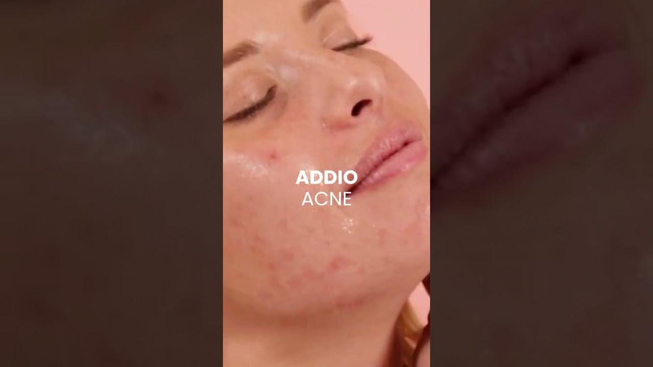 Brufoli e macchie dell'acne? Eliminali con Brufostop