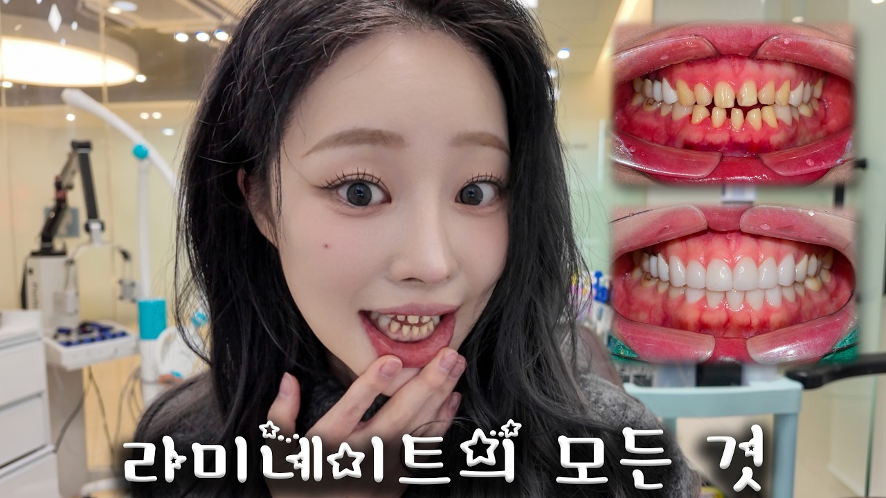 [가짜이빨의 삶] 라미네이트 새로 했어요😬시술 과정&비용&후기ㅣMINCARONG