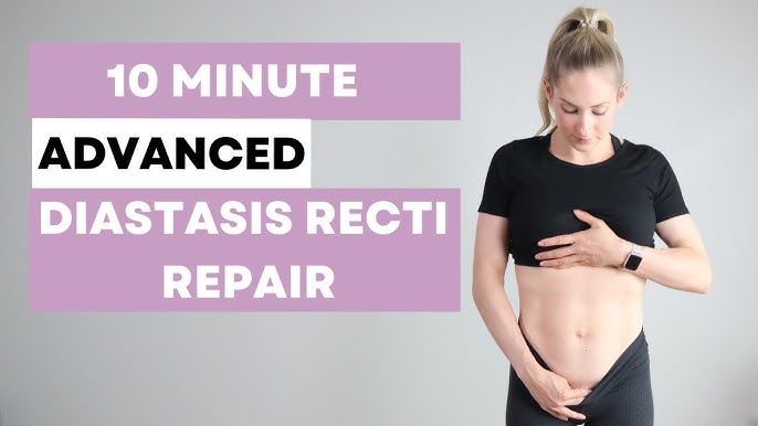 Diastasis Recti Repair Workout