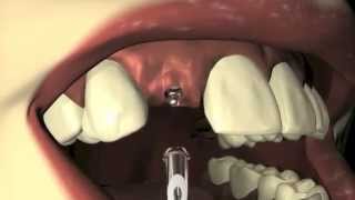 Milo 3.0mm Dental Implants: Part 2