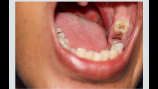 Teeth whitening and Tatar removal at home, DIY