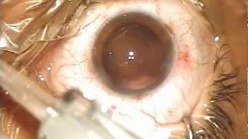 Succesful Implantation of a Swiss made EDOF IOL with our ErgoTouch FLY !