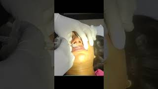 #fillertreatment, #lipfiller, #lipaugmentation Contact us: 01987-381188, 01718-105609, 01827-033209