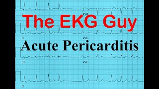 EKG/ECG in Acute Pericarditis | The EKG Guy - www.ekg.md