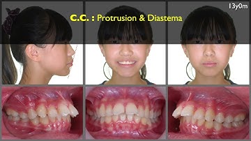 Solving Full cusp Class II with 12mm OJ｜【Chris Chang Ortho】CC742