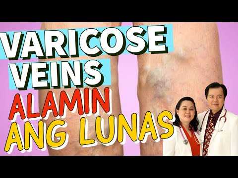 Video: 12 Mga Paraan upang Mapupuksa ang Mga Varicose Veins