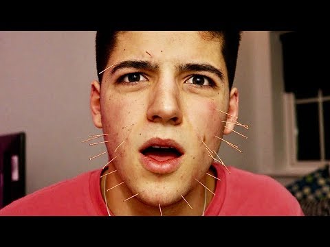 Trying acupuncture for the first time.. - Trying acupuncture for the first time..