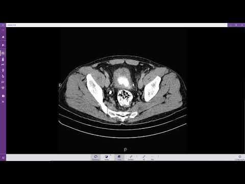 Vídeo: Como diagnosticar câncer de bexiga (com fotos)