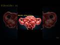 Is Infertility Actually Caused by Fibroids #WomensHealth #HealthFacts