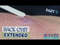 Part 33 massive back cyst extended  huevine