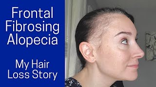 Frontal Fibrosing Alopecia | My Symptoms, Diagnosis, Treatments