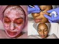 Acne & Ice Pick Scar Facial Treatment | GlamByLiaLeigh