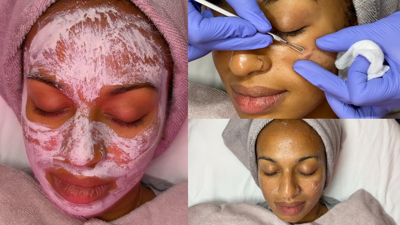 Acne & Ice Pick Scar Facial Treatment GlamByLiaLeigh YouTube