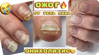 ТЕРМИЧЕСКИЙ ОЖОГ ногтевой пластины 😱 Огромный онихолизис 🙁 Маникюр