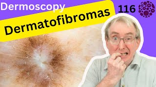 The Dermoscopy of Dermatofibromas and their management in Primary Care