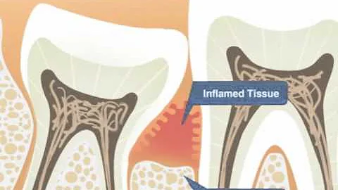 The 'Wisdom' Behind Wisdom Teeth Extraction - DayDayNews